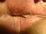 anal itching